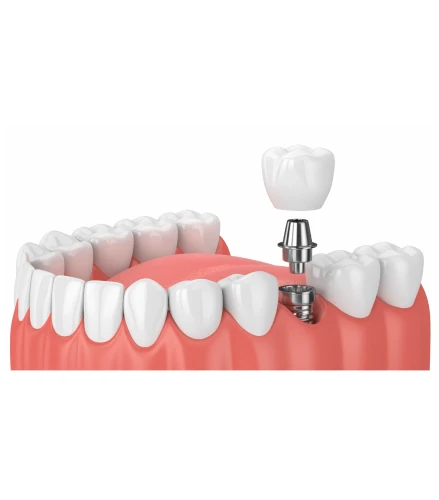 Single Implant